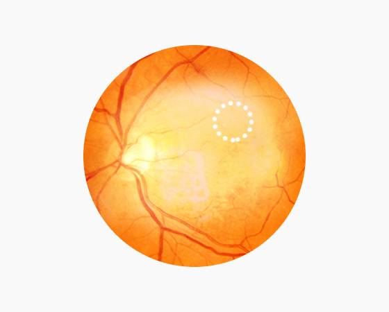 견인성 망막박리