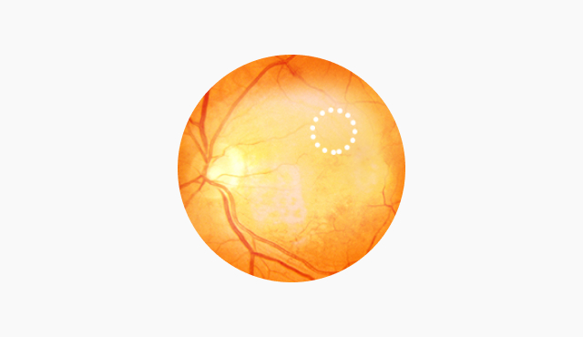 견인성 망막박리